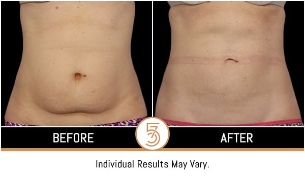 Coolsculpting in NYC Before and After Photos