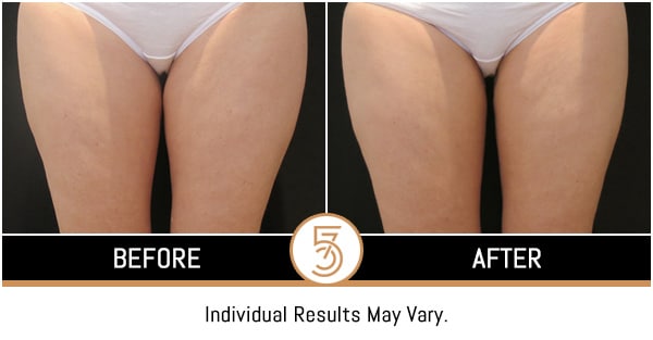 Coolsculpting in NYC Before and After Photos