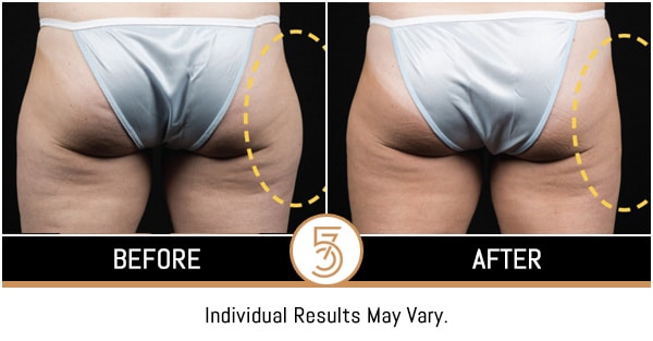 Coolsculpting in NYC Before and After Photos