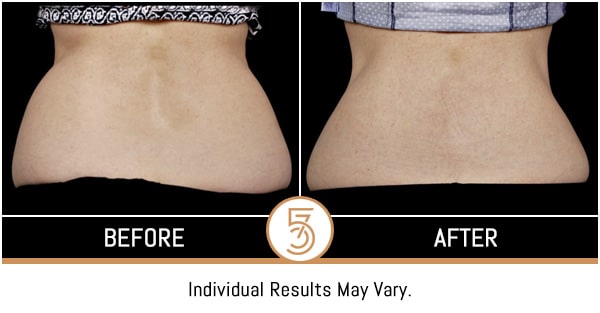 Coolsculpting in NYC Before and After Photos