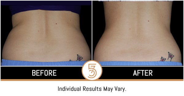 Coolsculpting in NYC Before and After Photos