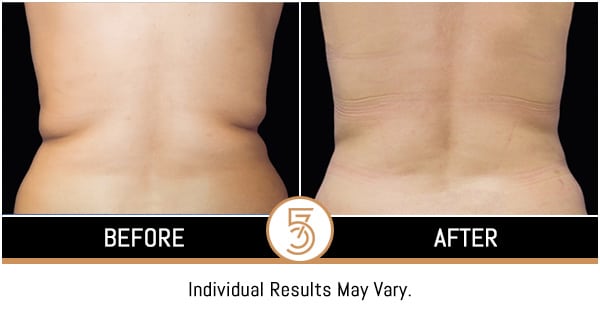 Coolsculpting in NYC Before and After Photos