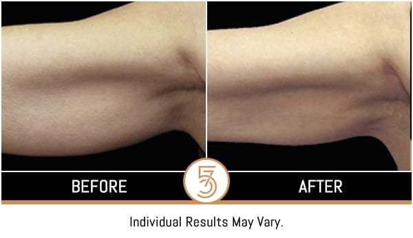 Coolsculpting in NYC Before and After Photos