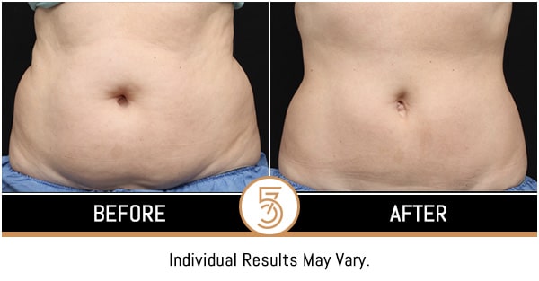 Coolsculpting in NYC Before and After Photos