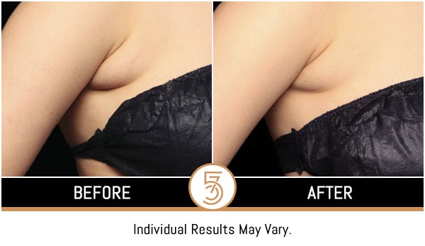 Coolsculpting in NYC Before and After Photos