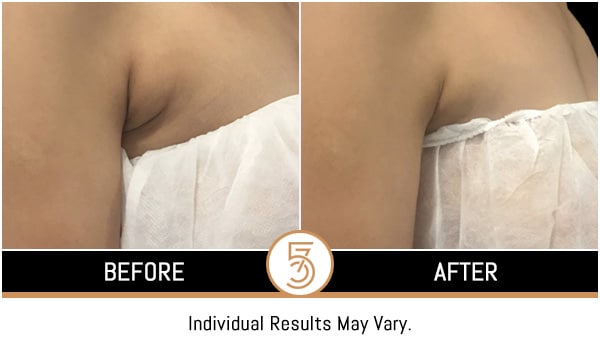 Coolsculpting in NYC Before and After Photos