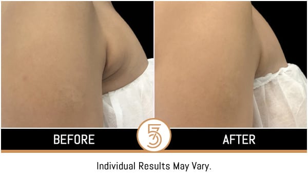 Coolsculpting in NYC Before and After Photos