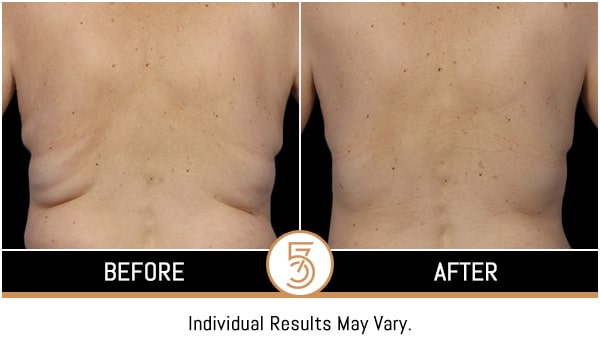 Coolsculpting in NYC Before and After Photos