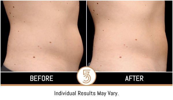 Coolsculpting in NYC Before and After Photos