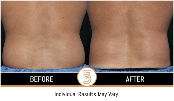 Coolsculpting in NYC Before and After Photos