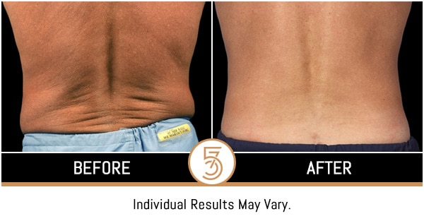 Coolsculpting in NYC Before and After Photos