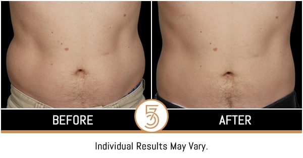 Coolsculpting in NYC Before and After Photos