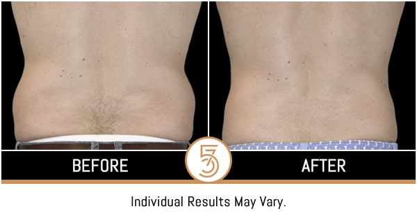 Coolsculpting in NYC Before and After Photos