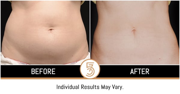 Coolsculpting in NYC Before and After Photos