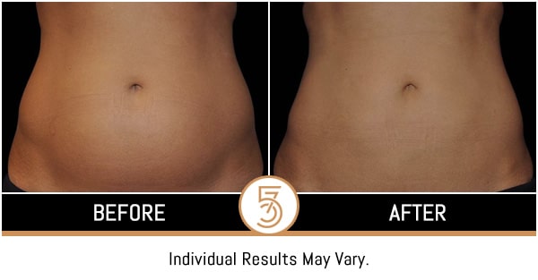 Coolsculpting in NYC Before and After Photos