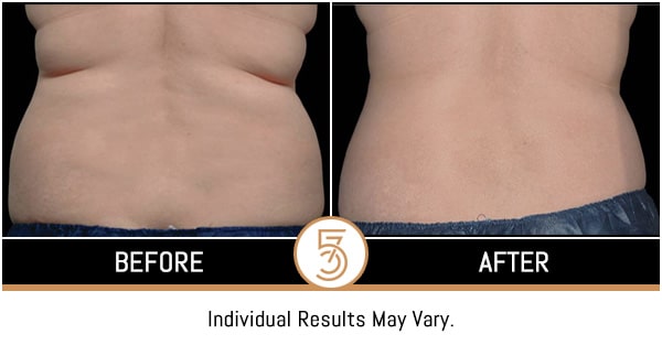 Coolsculpting in NYC Before and After Photos