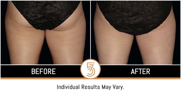 Coolsculpting in NYC Before and After Photos