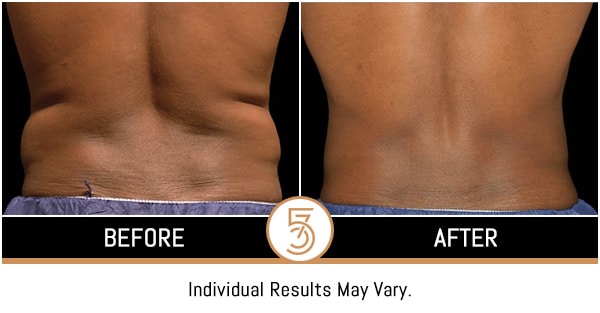 Coolsculpting in NYC Before and After Photos