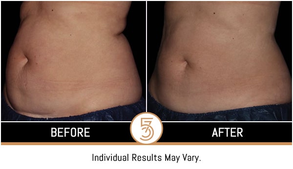 Coolsculpting in NYC Before and After Photos