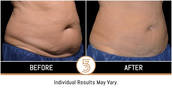 Coolsculpting in NYC Before and After Photos