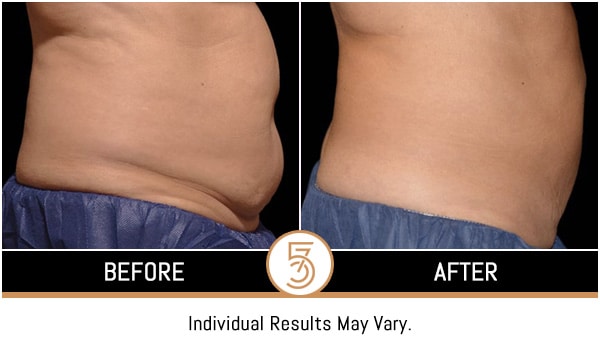 Coolsculpting in NYC Before and After Photos