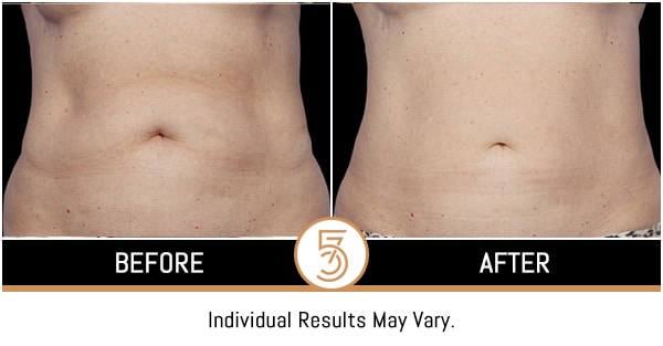 Coolsculpting in NYC Before and After Photos