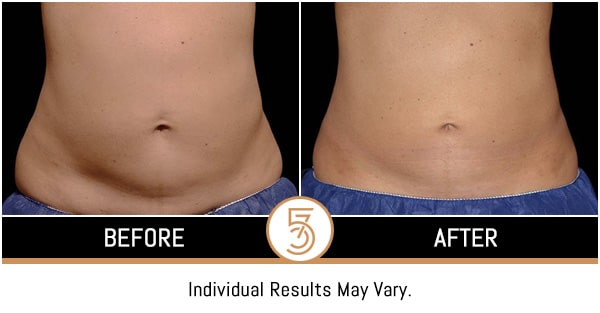 Coolsculpting in NYC Before and After Photos