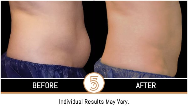 Coolsculpting in NYC Before and After Photos