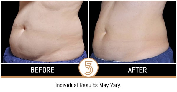 Coolsculpting in NYC Before and After Photos