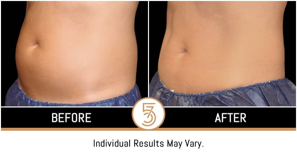 Coolsculpting in NYC Before and After Photos