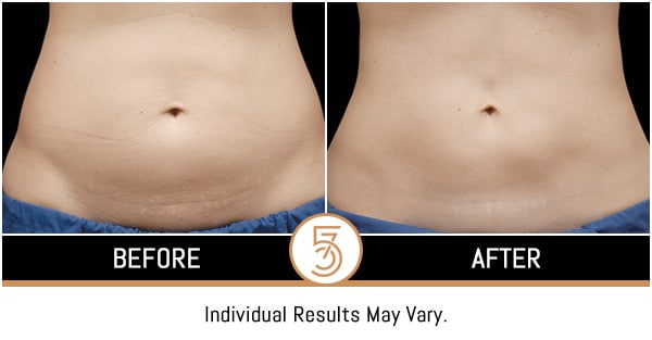 Coolsculpting in NYC Before and After Photos