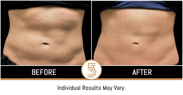 Coolsculpting in NYC Before and After Photos