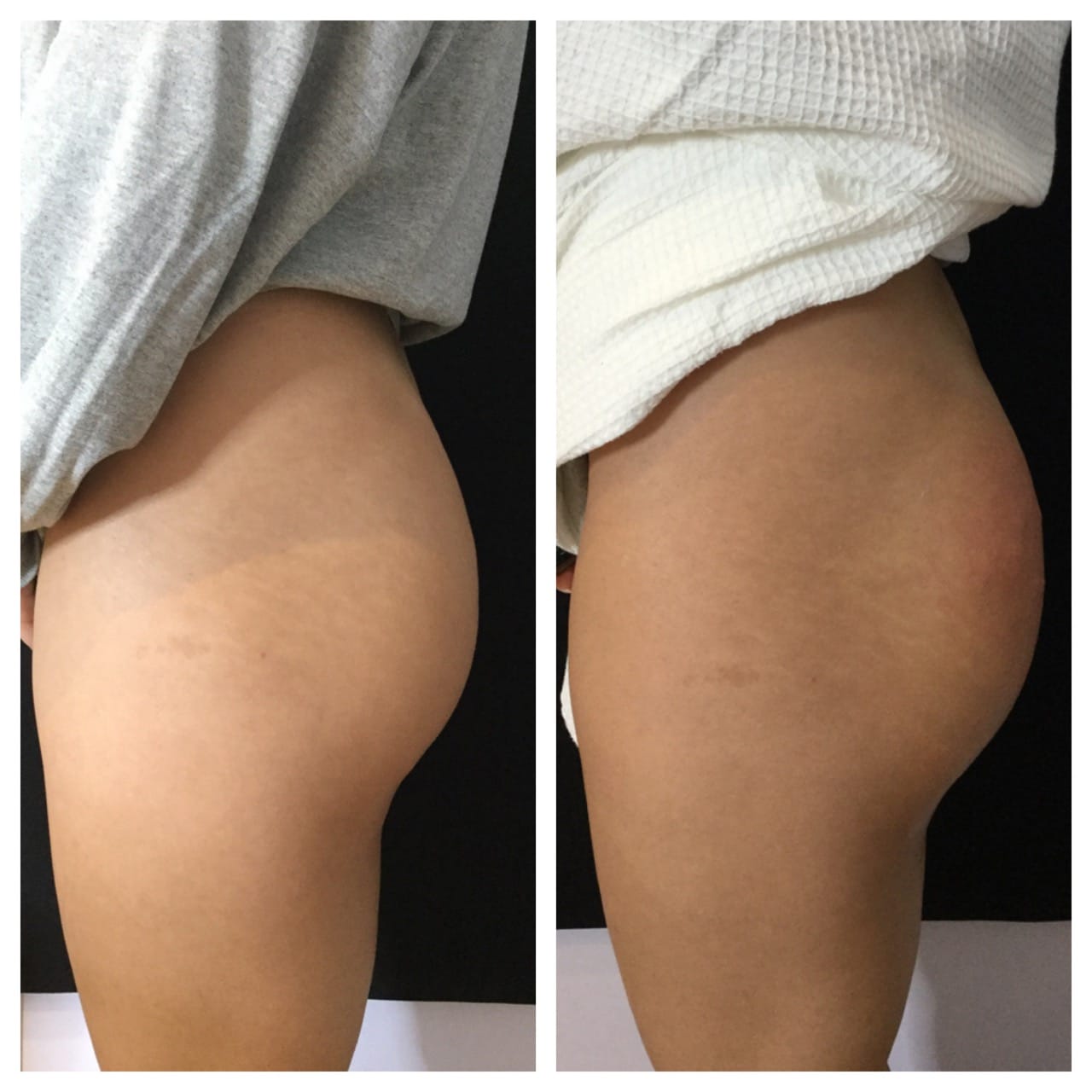Sculptra Injections for Hip Dips Treatments in Queens, NY